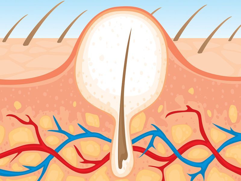 موی زیرپوستی چیست و چگونه درمان می‌شود؟